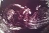 Baby scan 13 weeks